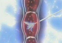 Склерозирование вен