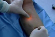 Эндовазальная лазерная коагуляция