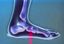 Стельки-ортезы