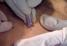 Лазерное удаление гемангиомы