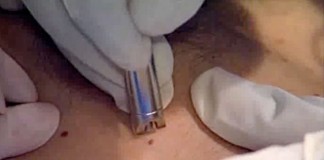 Лазерное удаление гемангиомы