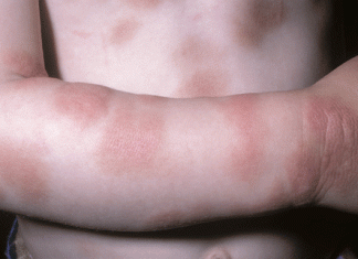 Мастоцитоз