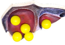 Программа «Жить Здорово» от 28.03.2017: Жировая болезнь (дистрофия) печени. Кому грозит цирроз