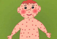 Программа «Жить Здорово» от 03.03.2017: Корь. Детская болезнь с недетскими последствиями