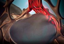 Боль в пояснице. Как ее вылечить?