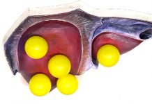 Программа «Жить Здорово» от 28.03.2017: Жировая болезнь (дистрофия) печени. Кому грозит цирроз