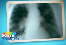 Программа «Жить Здорово» от 02.05.2017: Рак легких. Как не заболеть