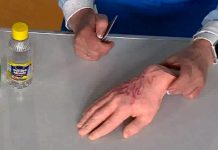 Программа «Жить Здорово» от 24.05.2017: Укус медузы. Как помочь самому себе