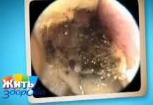 Программа «Жить Здорово» от 10.05.2017: Грибок в ушах. Чем опасна плесень в доме
