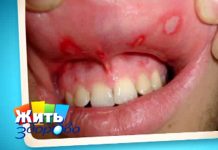 Программа «Жить Здорово» от 25.05.2017: Афтозный стоматит. Язвочки во рту