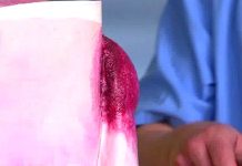 Программа «Жить Здорово» от 04.05.2017: Панариций. Как уберечься от нагноений на пальцах