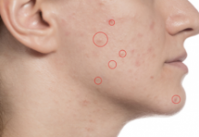 Как правильно лечить прыщи