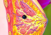 Программа «Жить здорово» от 8.11.2017: Еда против рака груди