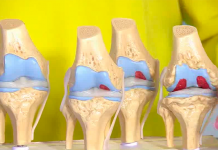 Программа «Жить здорово» от 22.12.2017: Остеоартроз: боль в коленных суставах