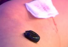 Программа «Жить здорово» от 30.01.2018: Альтернативная медицина. Гирудотерапия (лечение пиявками)