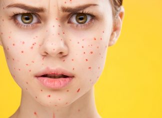 Есть ли связь между стрессом и акне?