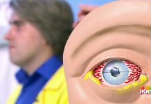 Программа «Жить здорово» повтор от 27.08.2018: Конъюнктивит. Симптомы и лечение