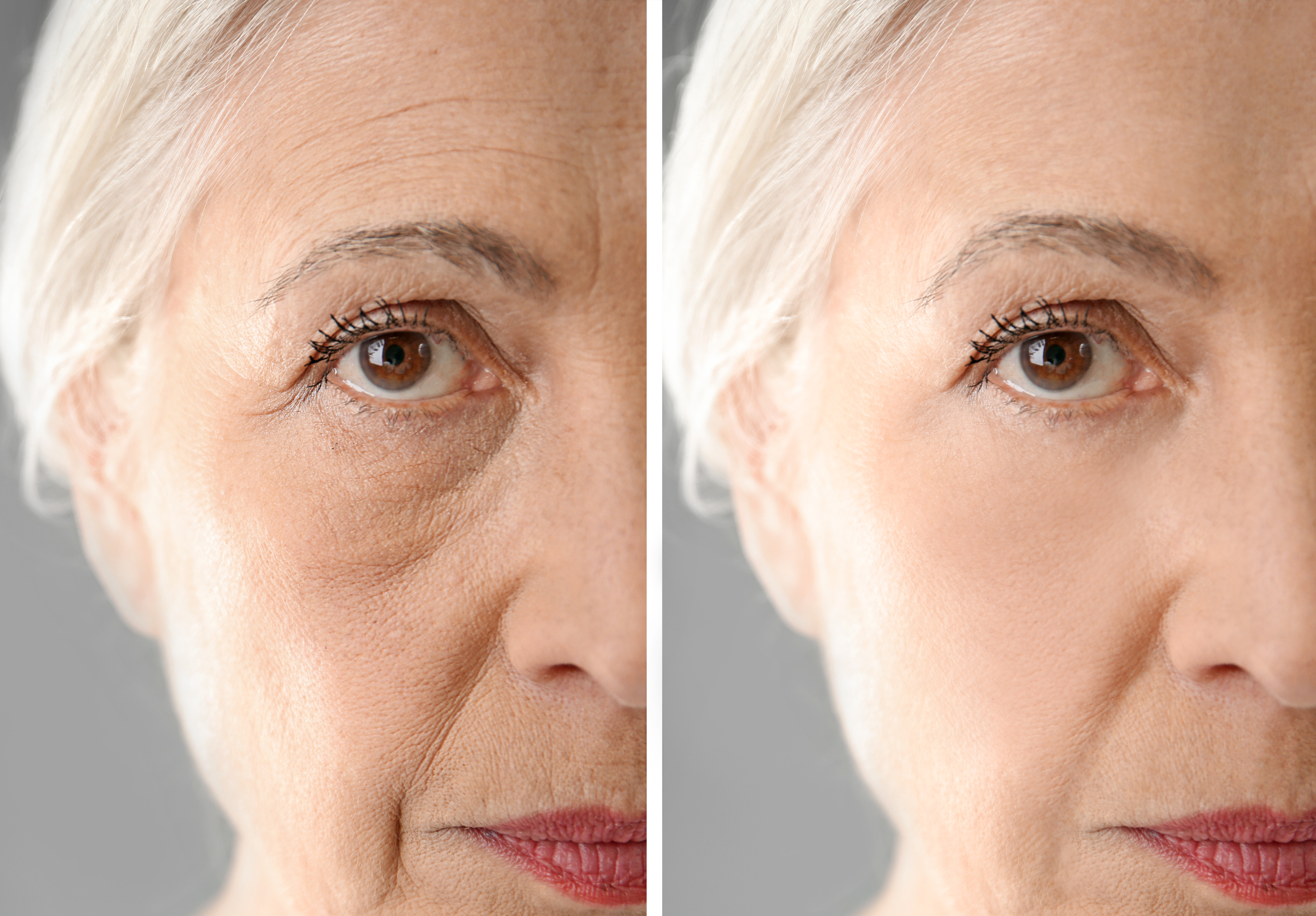 Биоревитализация глаз эффект. Женщина с морщинами. Омоложение лица. Морщины на лице. Возрастные морщины.