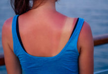 Солнечный ожог: что делать?