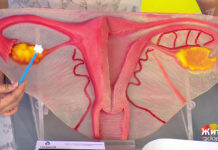 Программа «Жить здорово» от 19.11.2018: Рак шейки матки