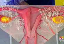 Программа «Жить здорово» от 24.01.2019: Когда все запутано. Спайки