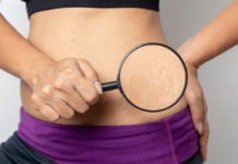 Как избавиться от растяжек