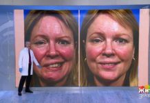 Программа «Жить здорово» от 26.06.2019: Вернуть улыбку: паралич Белла