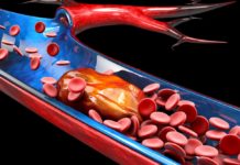 Тромбоз: что это за состояние и как его избежать