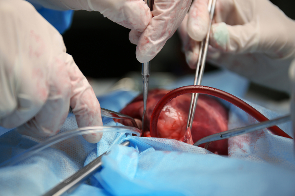 Первая операция по пересадке сердца