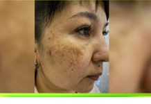 Программа «Жить здорово» от 16.04.2021: Хватит это терпеть! Пигментные пятна