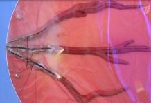 Программа «Жить здорово» от 26.06.2023: Три опасности для глаз в отпуске