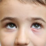 Не в бровь, а в глаз. Ячмень