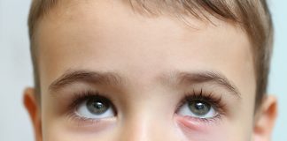 Не в бровь, а в глаз. Ячмень