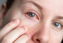 Конъюнктивит: как его быстро вылечить