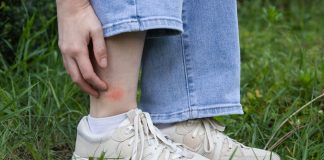 Гаджет от укусов: реально ли убрать зуд за 1 минуту?